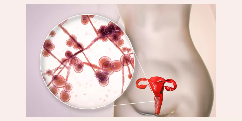 Mastologista Sao Paulo Alteracao Hormonal Quarentena vaginite