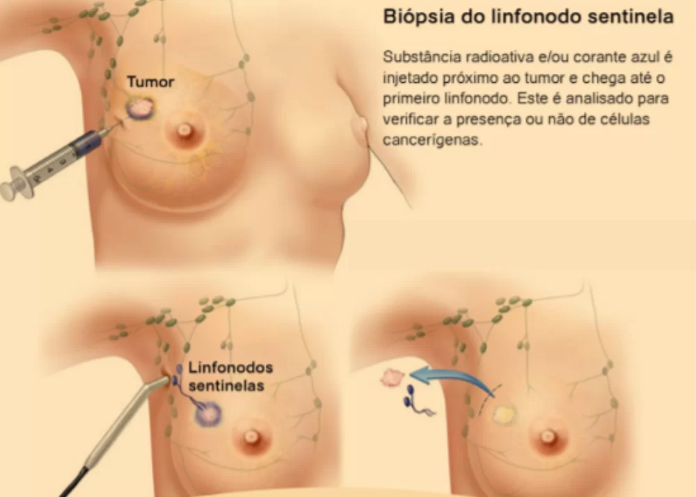 Mastologista sao paulo biopsia de linfonodo sentinela